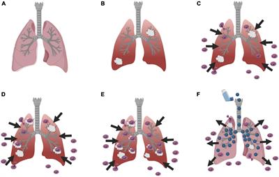 Using Dictyostelium to Develop Therapeutics for Acute Respiratory Distress Syndrome